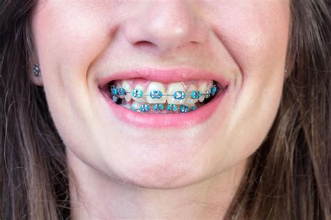 Braces & Smiles Limefield Dental Specialist Centre