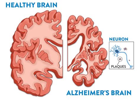 Brain of Alzheimer's patient
