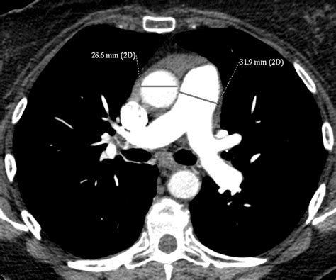 CT Pulmonary Angiogram