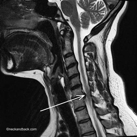 Herniation MRI