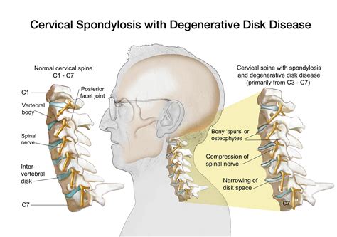 Spondylosis Symptoms