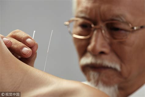 Chinese acupuncture&herbs
