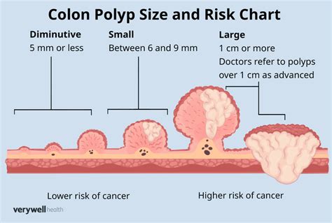 Colon Polyp Size Chart