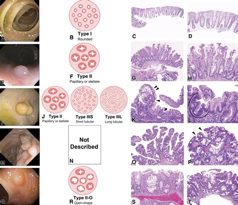 Polyps Types