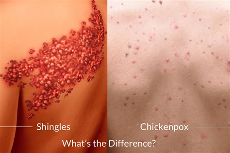 Complications of Chickenpox and Shingles