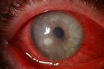 Corneal Infection