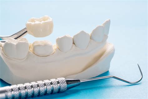Pemasangan crown atau mahkota gigi