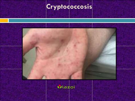 Cryptococcosis Symptoms