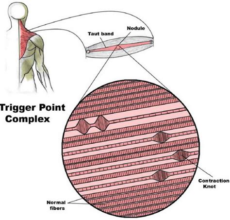 Deep Tissue Trigger Point Myofascial Active Release Neuro Muscular Therapy Muscle Energy