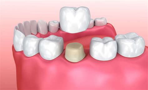 Dental Crown Core