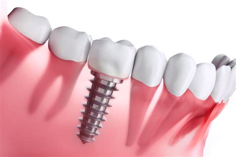 Dental Implant as an Alternative