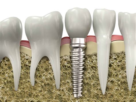 Dental Implants Abroad