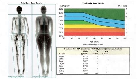 Dexa Scan Chart