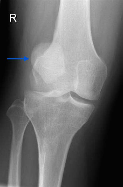 Dislocated Patella