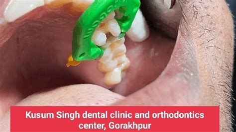 Dr. Sanjay Singh Dentist BDS ( Shanvi Hospital Gorakhpur)