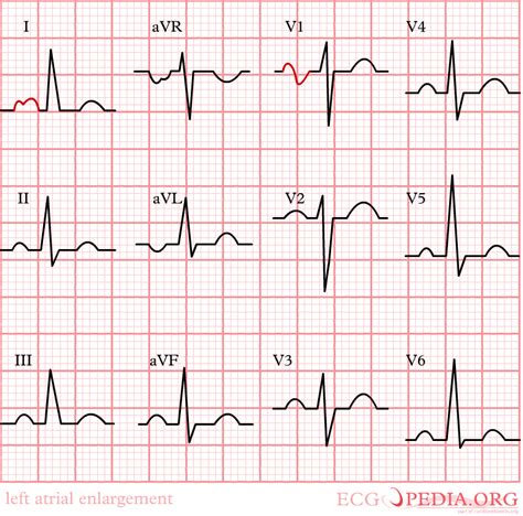 EKG Examples