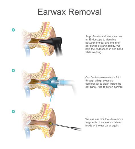 Earwax removal 2U