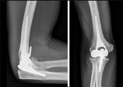 Elbow Joint Replacement