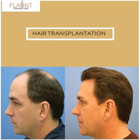 FLAUNT Hair Transplant