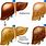 Fat Liver Disease