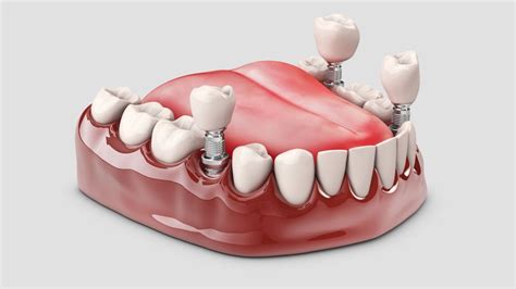 Gigi Palsu atau Implant