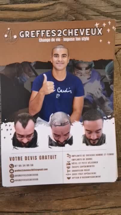 Greffes2Cheveux à Malakoff