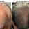 Hair Loss Before and After