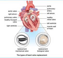 Heart Valve Replacement