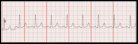 Hyperkalemia EKG Strip