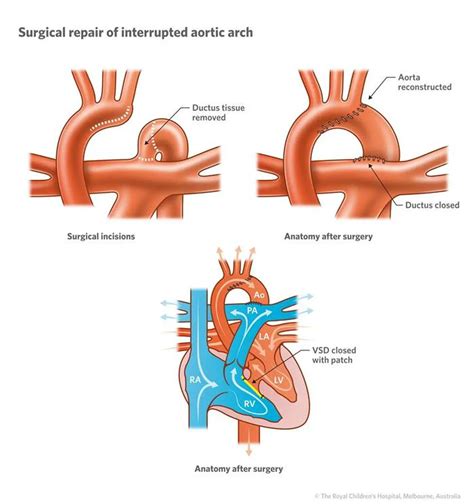 Aortic Arch Types