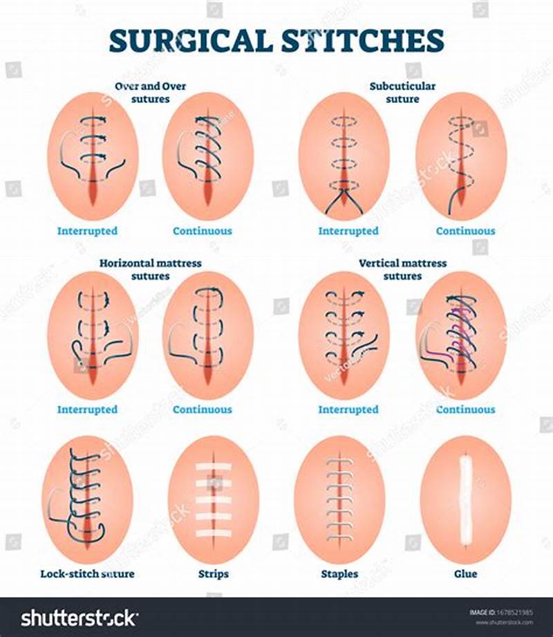 Interrupted Suture Pattern