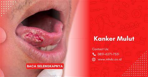 Kanker Mulut