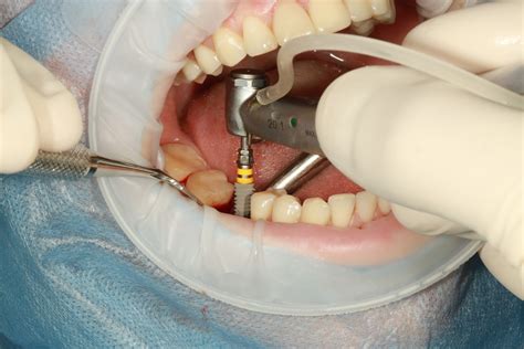Kieferchirurgie - Implantologie München - Zahnarzt - Mund-Kiefer-Gesichtschirurgie - Zahnimplantate - Zahnmedizin - Medizin