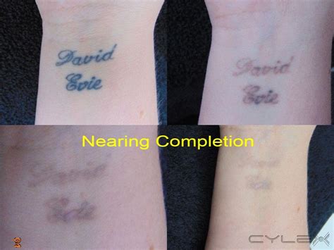Laser Eraser Tattoo and Pigment Removal Services