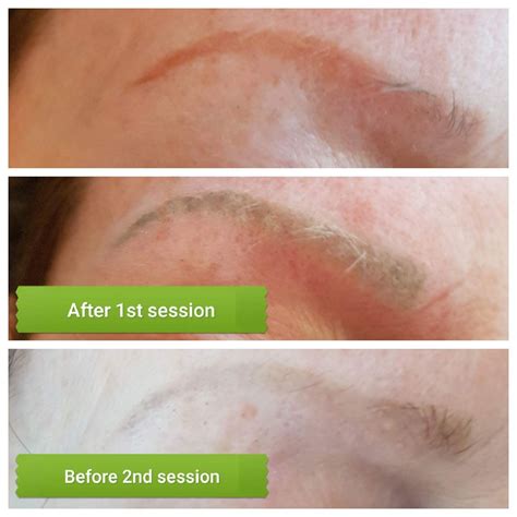 Lorena Oberg Skincare Permanent Makeup/SMP Removal