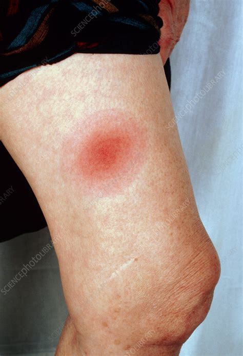 Erythema Migrans