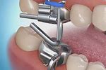 Mara Orthodontic Appliance Activation