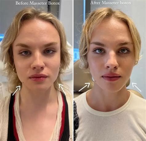 Masseter Botox Self-Confidence