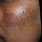 Melasma On Black Skin