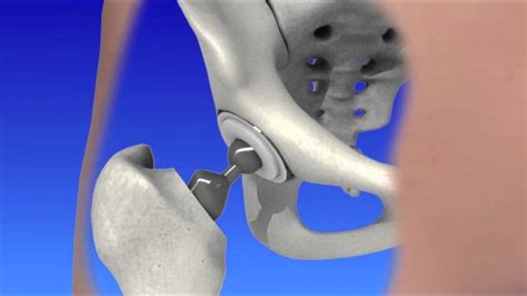 Invasive Hip Surgery