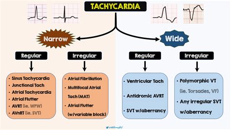 Tachycardia Differential