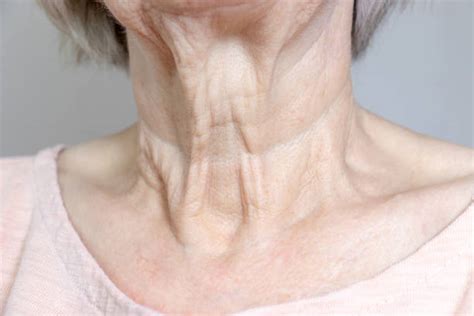 Neck Wrinkles Causes and Types