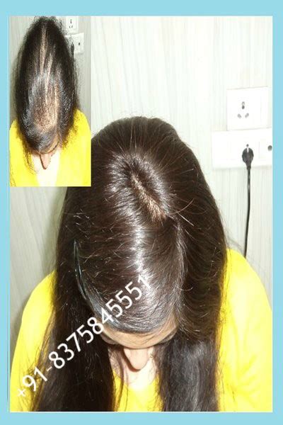 No.1 Sardarji Non Surgical Hair Fixing- Hair Weaving- Natural Human Hair Wig