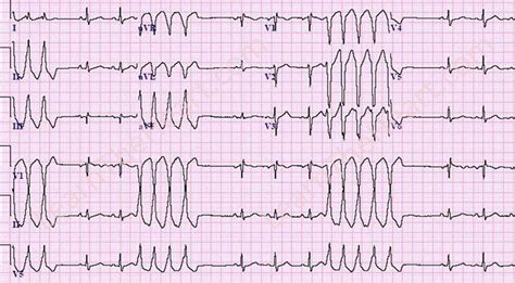 Nonsustained Ventricular