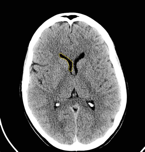 Brain CT Scan Head