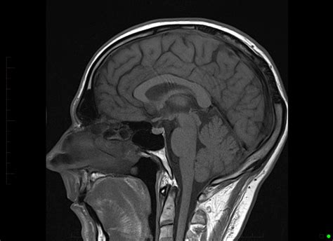 Normal Brain MRI