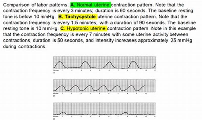 Normal Contraction Pattern