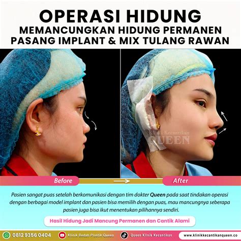 Operasi
