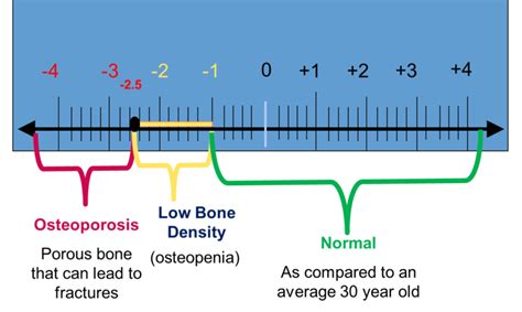 Osteoporosis T Score Chart
