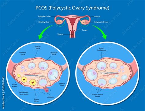 PCOS